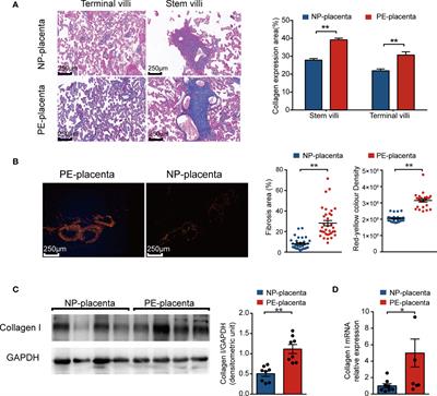 Collagen I Induces Preeclampsia-Like Symptoms by Suppressing Proliferation and Invasion of Trophoblasts